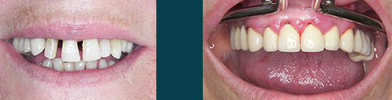 Simptomi paradentoze