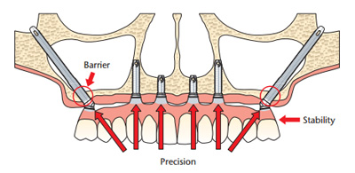Zigomatični implantati