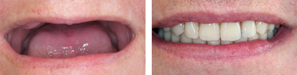 Cirkularni mostovi nad implantatima prije i poslije